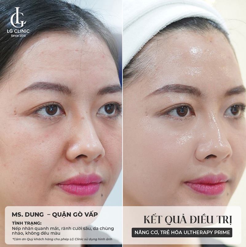 kết quả sử dụng ultherapy prime
