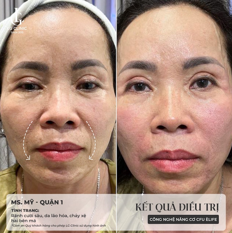 hình thực tế khi sử dụng cfu