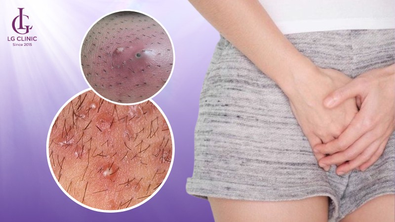 Vùng kín nổi mụn ngứa 1