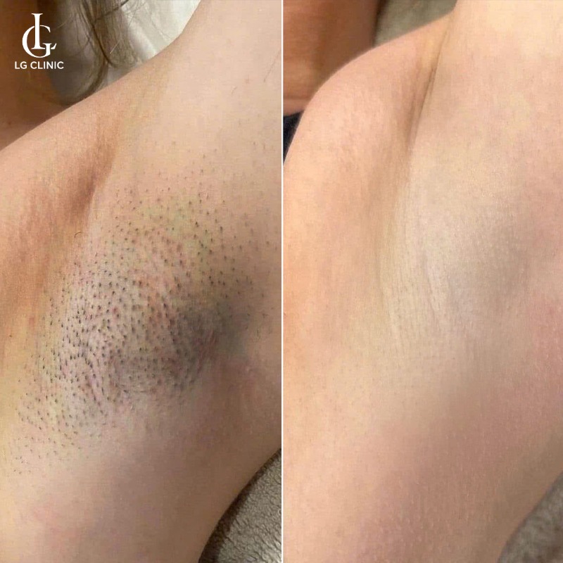 bắn laser bao lâu thì bắn lại