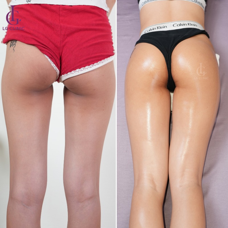 bắn laser bao lâu thì bắn lại