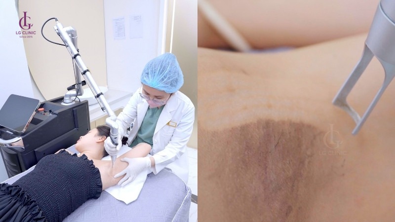 bắn laser bao lâu thì bắn lại