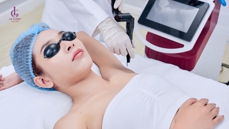 bắn laser bao lâu thì bắn lại