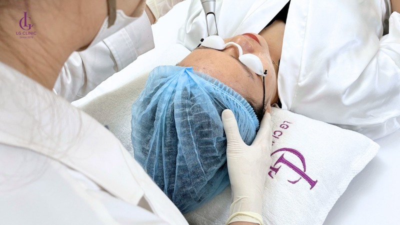 bắn laser bao lâu thì bắn lại