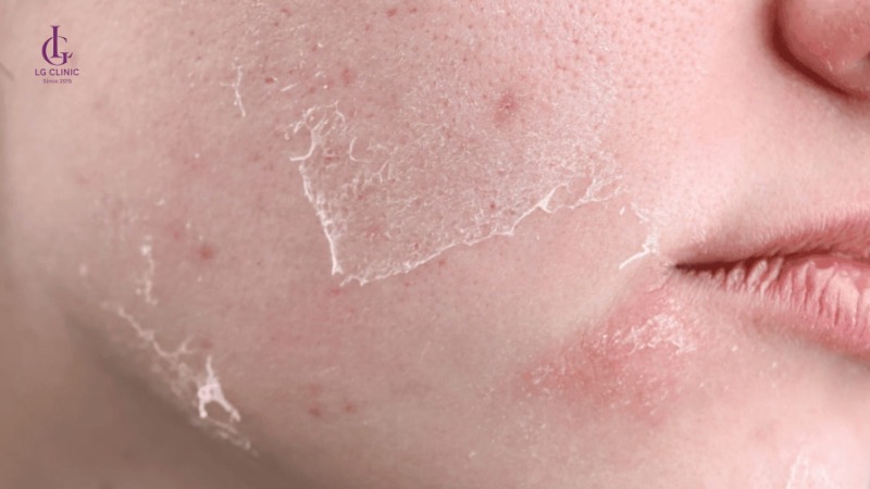 bắn laser bao lâu thì bắn lại