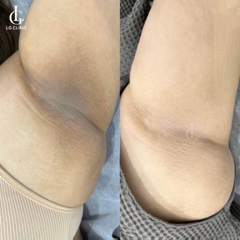 bắn laser trị thâm