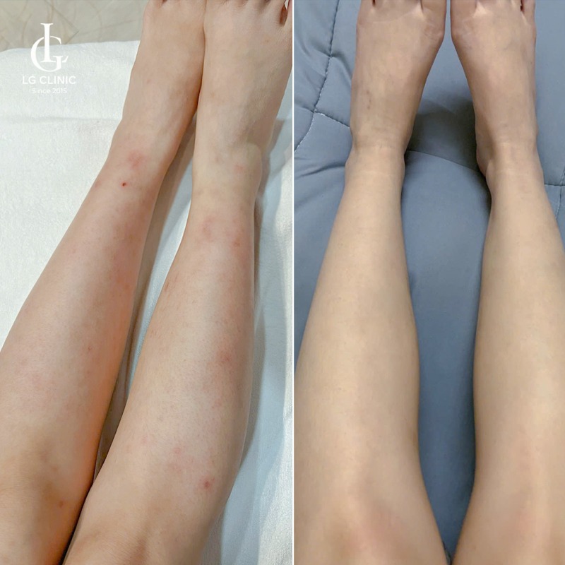 bắn laser trị thâm