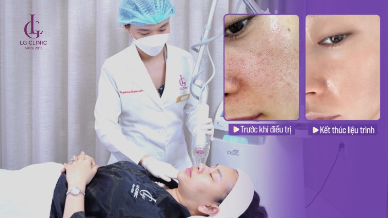 dịch vụ thu nhỏ lỗ chân lông