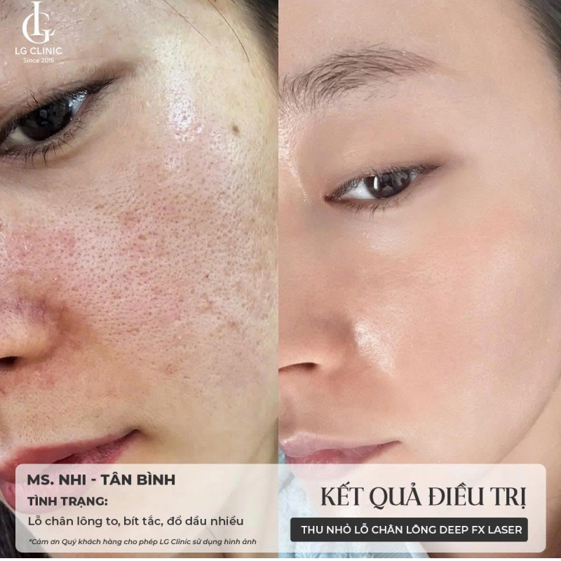 dịch vụ thu nhỏ lỗ chân lông