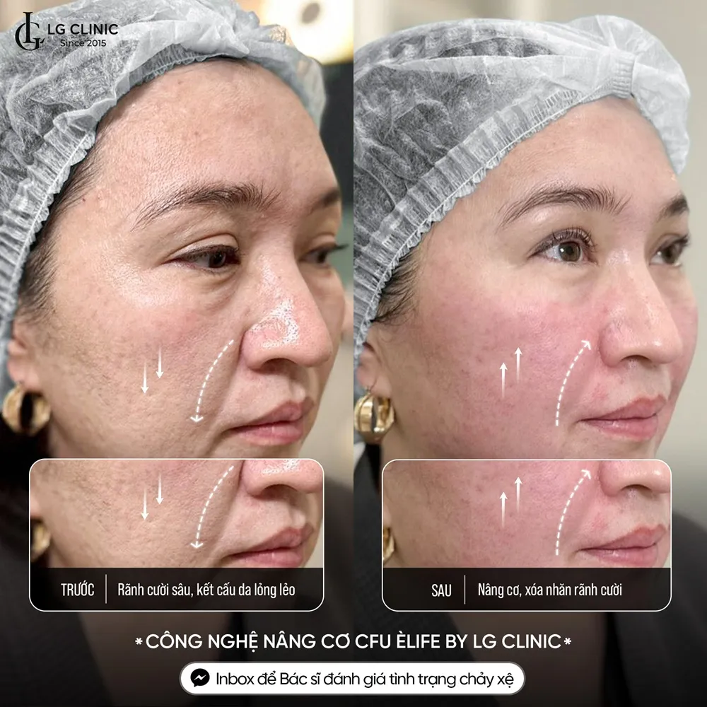 Hình ảnh khách hàng nâng cơ cfu