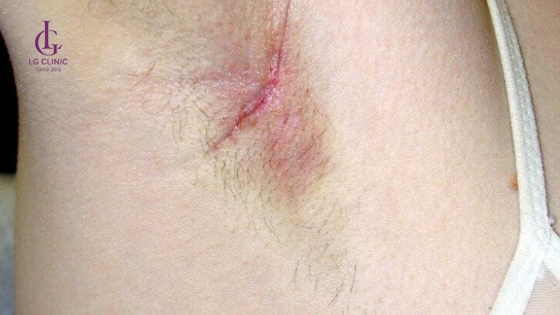 kem trị thâm nách