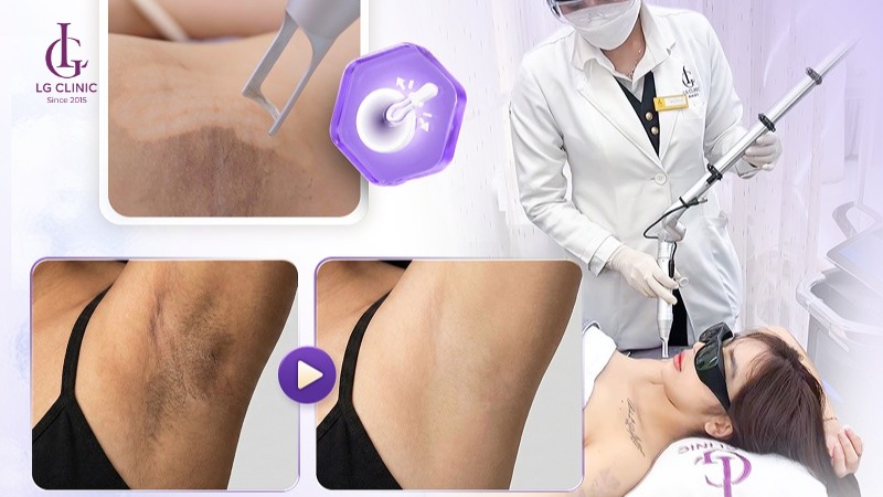 kem trị thâm nách