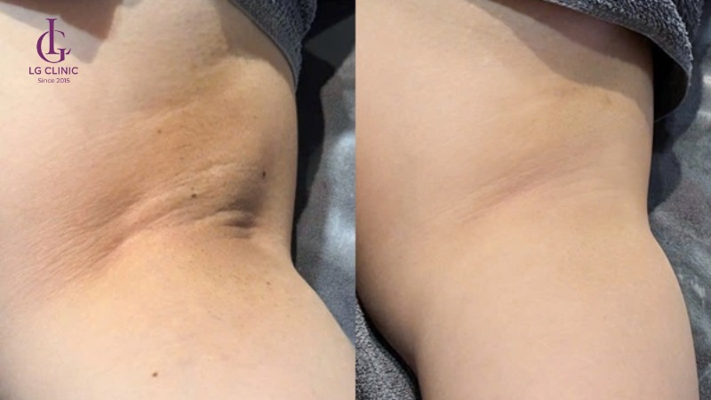 kem trị thâm nách