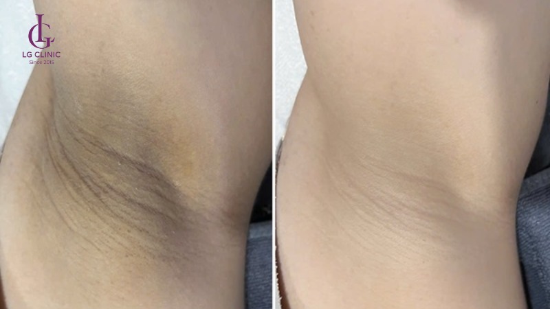 kem trị thâm nách