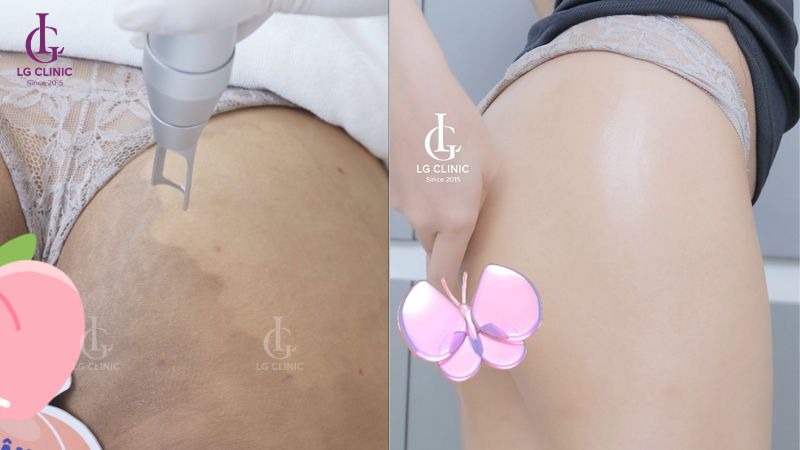 kinh nghiệm điều trị thâm mông tại spa