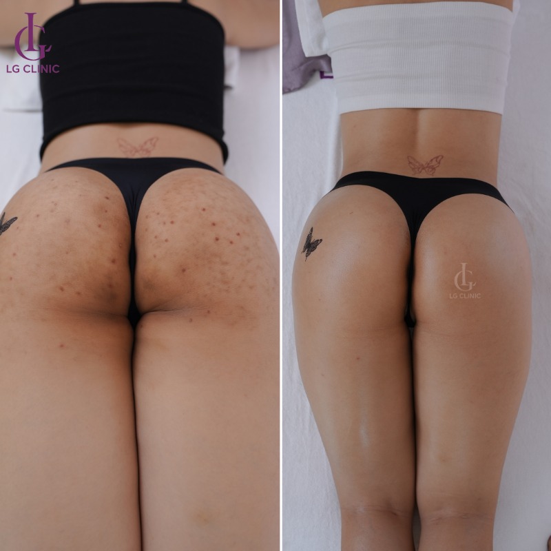 kinh nghiệm điều trị thâm mông tại spa