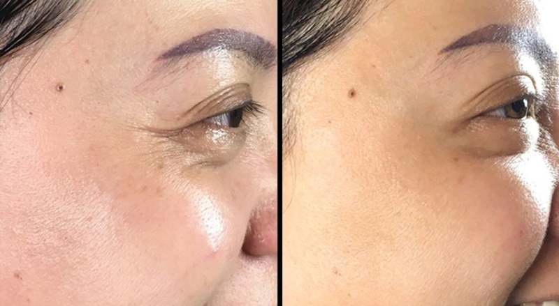 nếp nhăn đuôi mắt