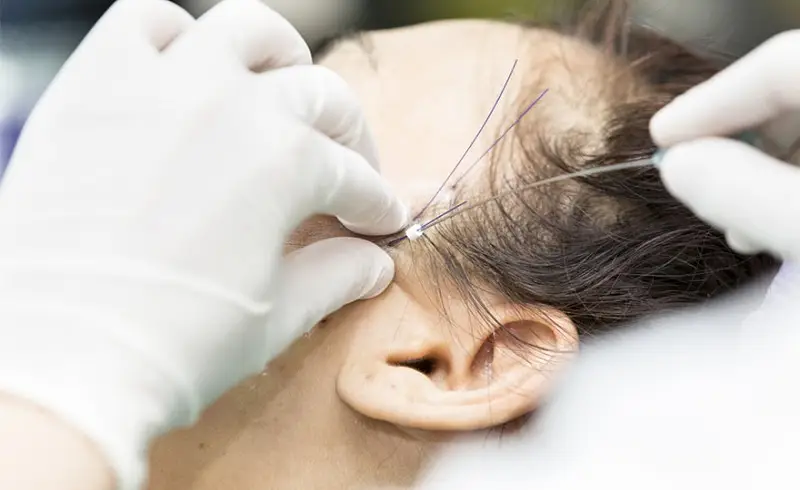 căng chỉ xoá nếp nhăn đuôi mắt