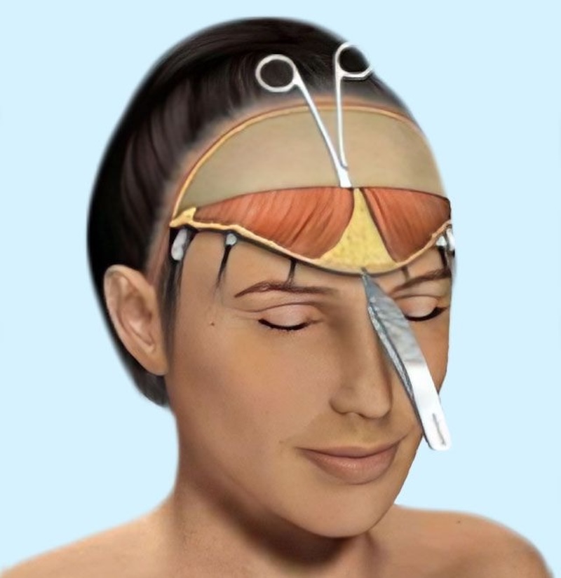 phẫu thuật căng da trán