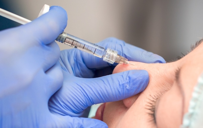 tiêm botox xoá nếp nhăn mũi