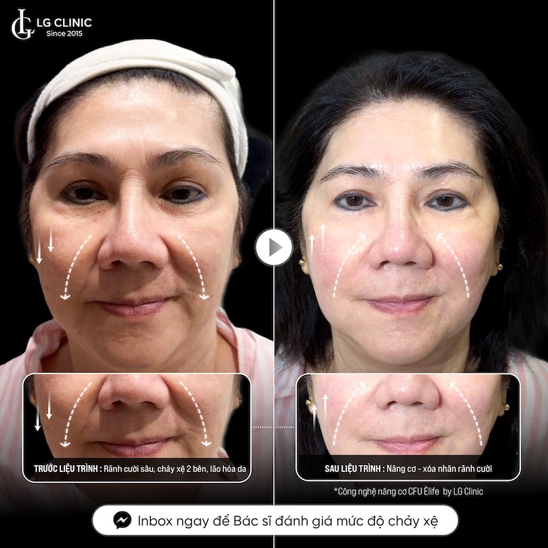 xoá nếp nhăn rãnh mũi má