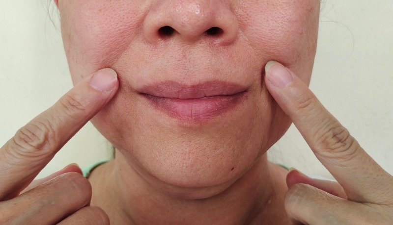 nếp nhăn rãnh mũi má