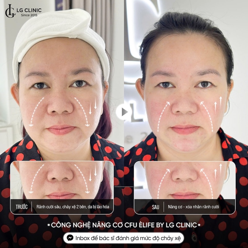 xoá nếp nhăn rãnh mũi má