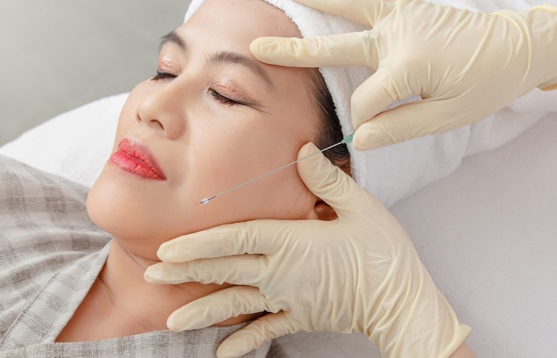 cẳng chỉ xoá nếp nhăn rãnh mũi má