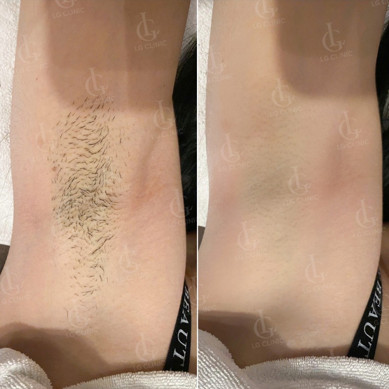 Ra mồ hôi nách có phải bị hôi nách không