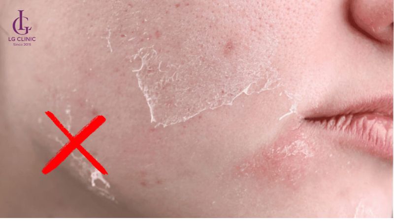 sau khi bắn laser nên bôi gì