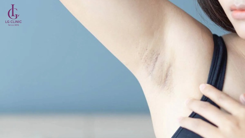 tại sao lông nách mọc ít