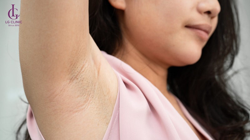 tại sao lông nách mọc ít