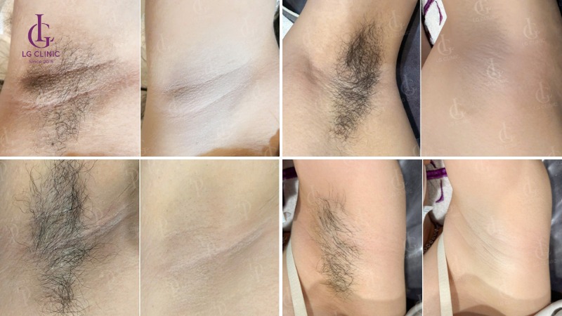 tại sao lông nách mọc ít