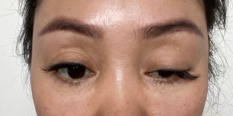 biến chứng sụp mí