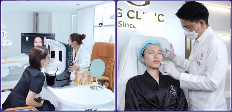 tiêm botox xoá nhăn đuôi mắt tại lg clinic
