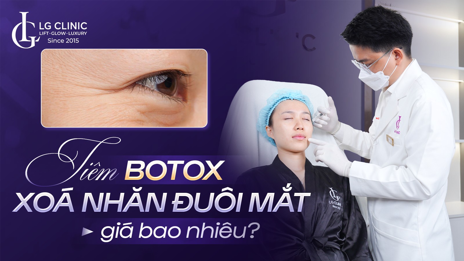 Tiêm botox xóa nhăn đuôi mắt giá bao nhiêu?