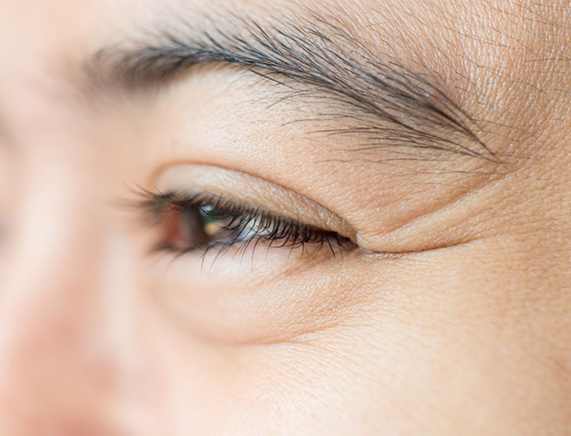 tiêm xoá nhăn đuôi mắt