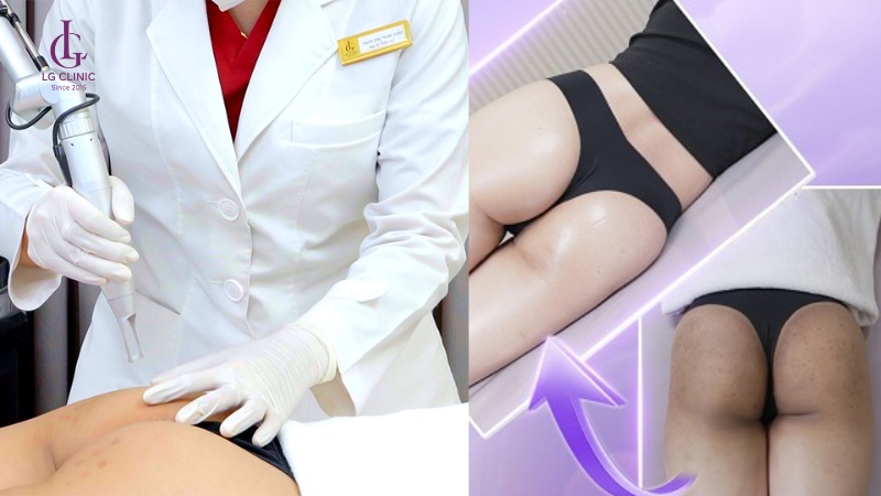 xà phòng trị thâm mông