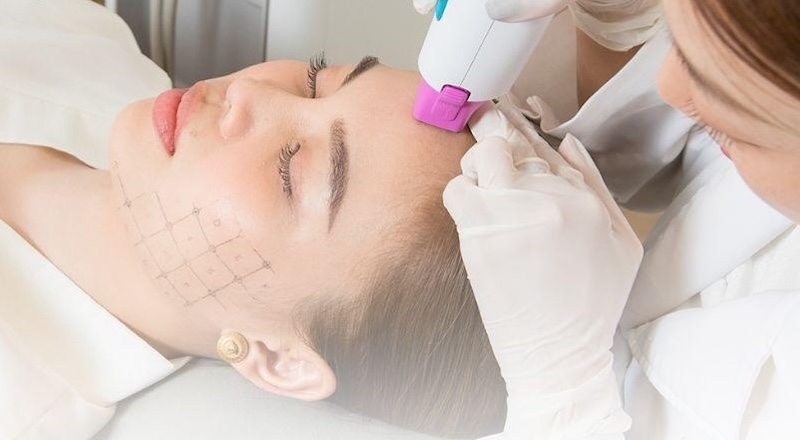 xóa nếp nhăn vùng trán bằng công nghệ RF