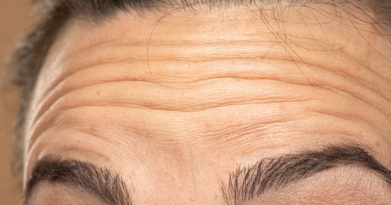 nếp nhăn trên trán