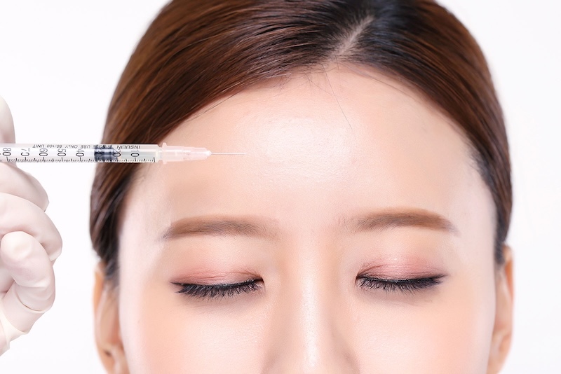 tiêm botox xoá nếp nhăn trán