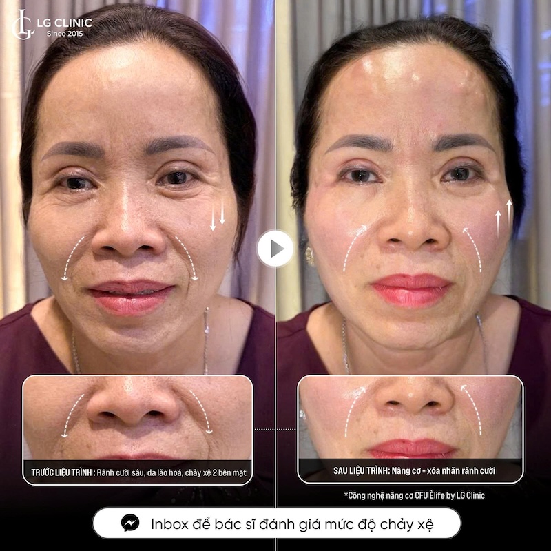 xoá nếp nhăn tại lg clinic