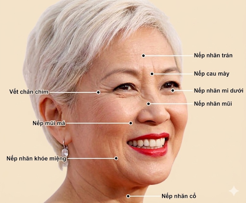 các vị trí nếp nhăn trên mặt