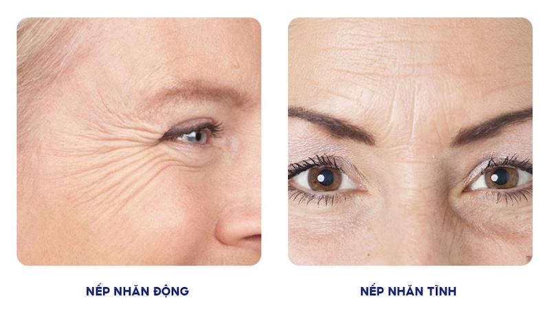 các loại nếp nhăn