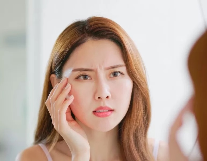 nếp nhăn ấn đường