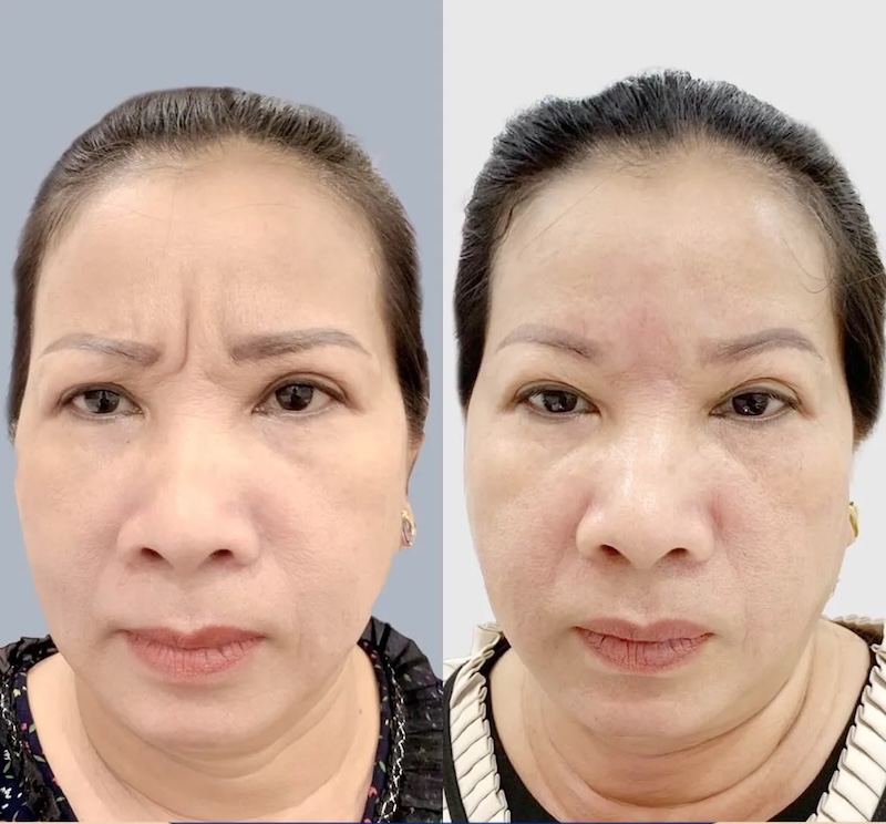 kết quả xoá nhăn cau mày