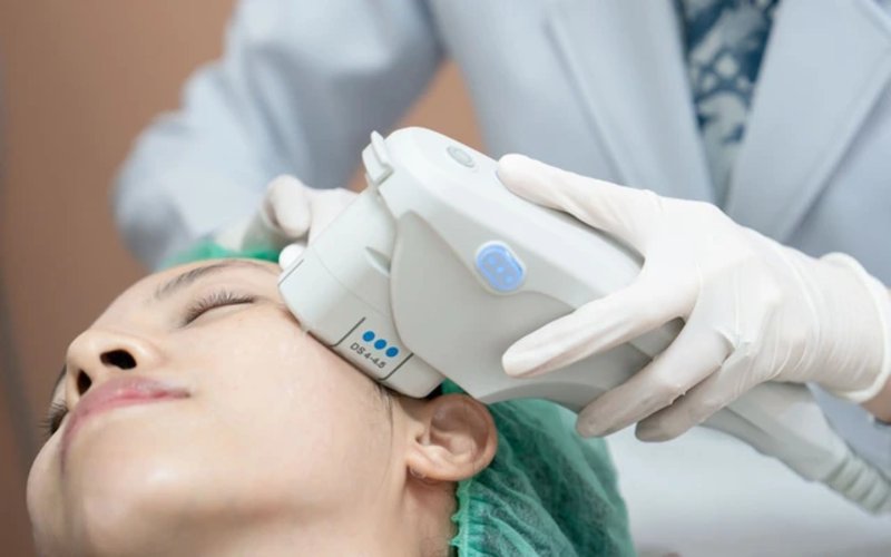 Ultherapy nâng cơ đuôi mắt