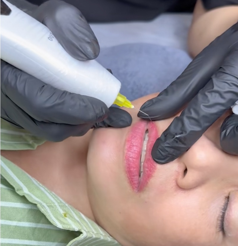 xoá nhăn môi bằng plasma