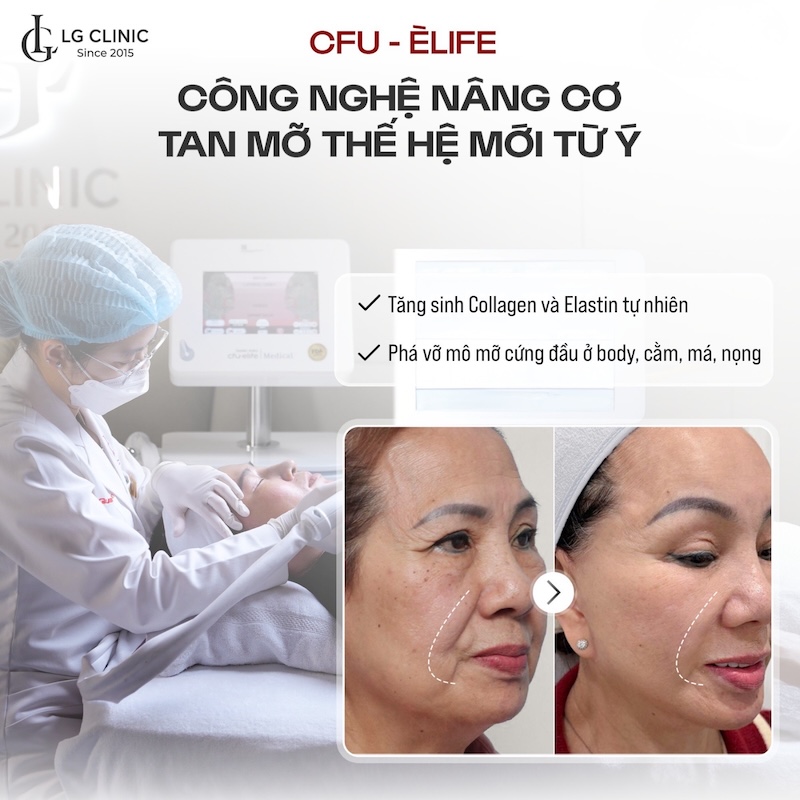 xoá nhăn nâng cơ cfu èlife