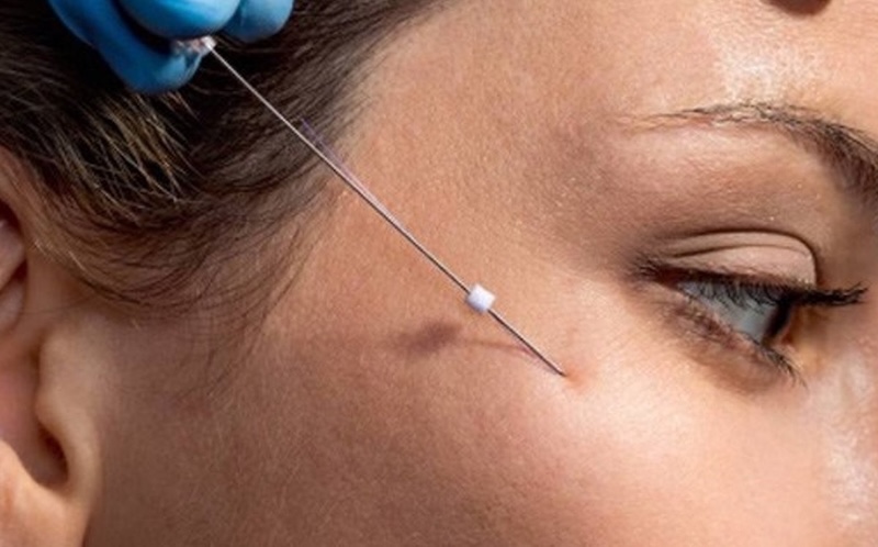 căng chỉ xoá nếp nhăn mắt